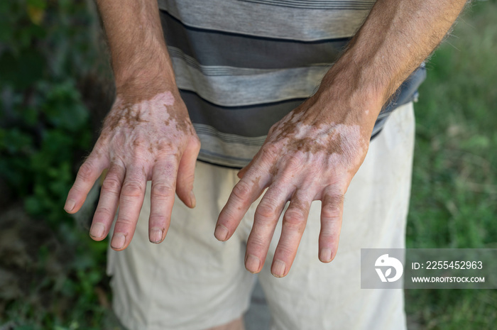 Symptoms of vitiligo on the skin on the hands of a man