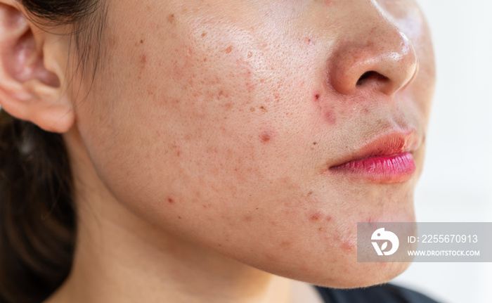 Cropped shot of woman having problems of acne inflamed on her face. Inflamed acne consists of swelli