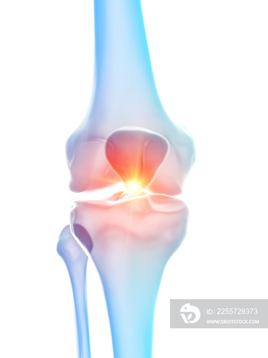 膝关节疼痛的三维医学精确图示