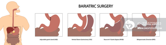 Bariatric Surgery - Different types of bariatric procedures