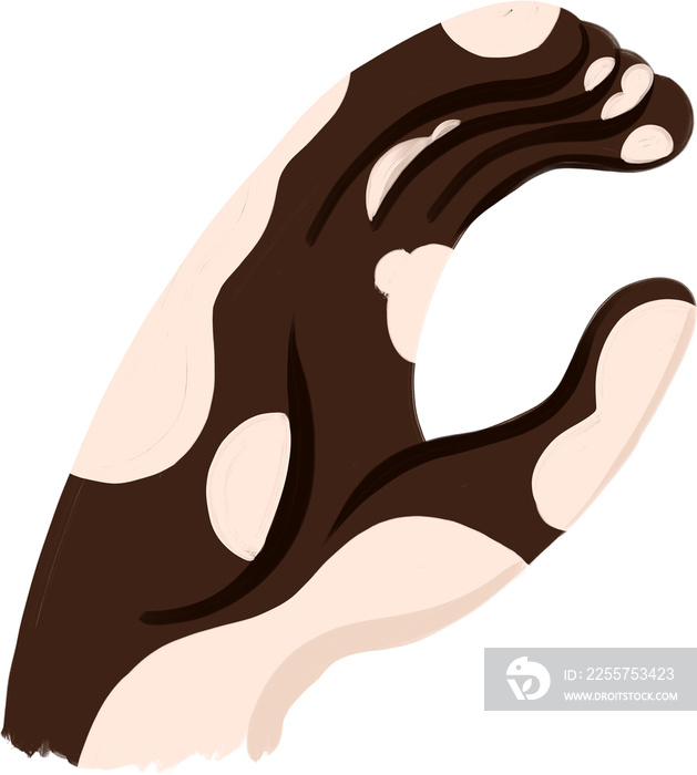 Spanish ASL Vitiligo Hands C