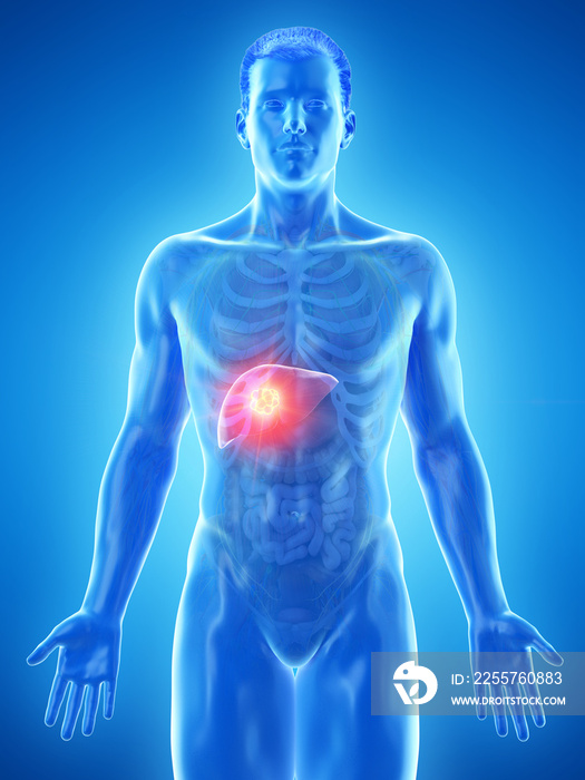 3d rendered medically accurate illustration of a mans liver tumor