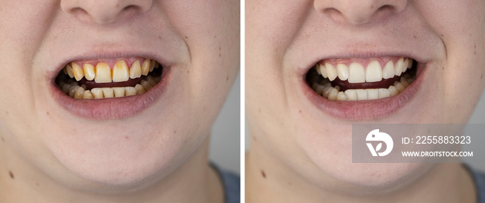 Teeth of a man before and after bleaching. The dentist removed yellow plaque from tooth enamel. The concept of professional toothbrushing in a dental clinic