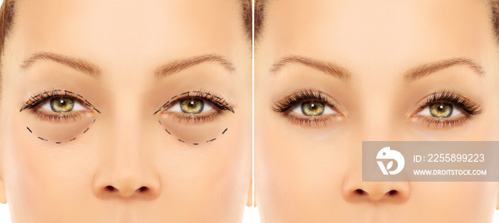 Lower eyelid blepharoplasty.Upper  blepharoplasty.Before and after cosmetic procedures