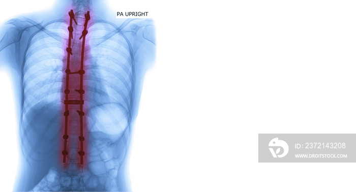 X-ray image of spine show Scoliosis deformity surgery fix by long metal rod and many screw for spina