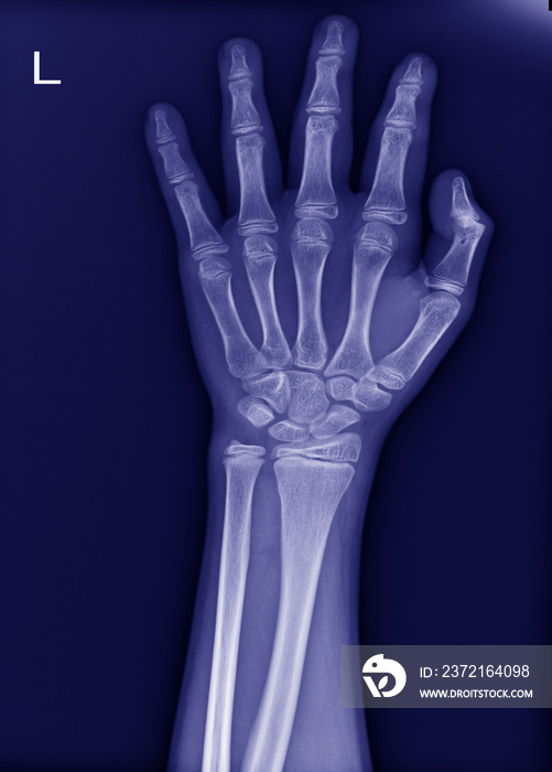 左手腕x光检查无骨折，关节正常。
