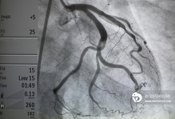 冠状动脉造影，心脏病的医学x光检查。冠状动脉疾病。