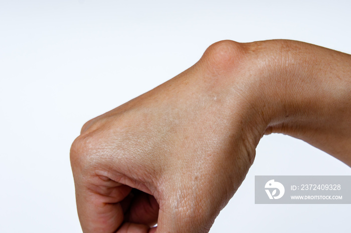 Ganglion cyst on woman hand on white background