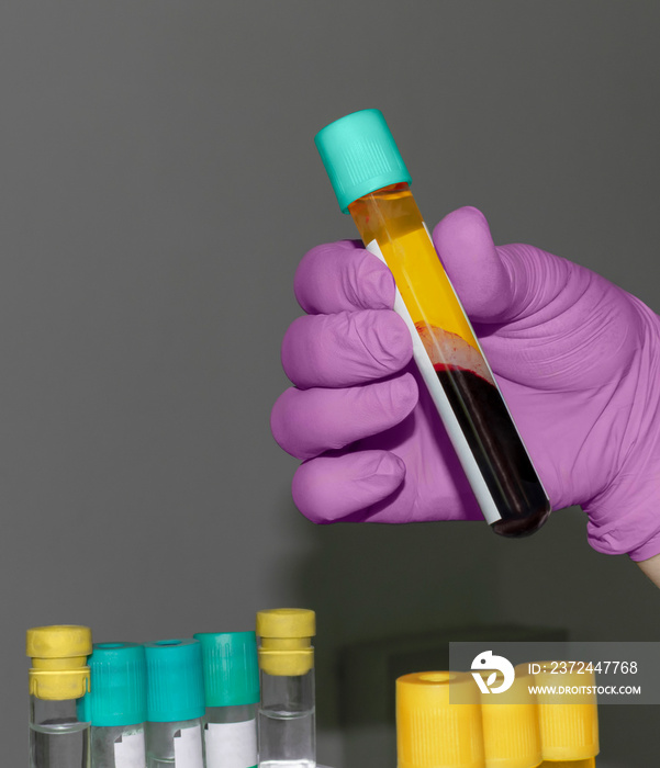 Test tube with plasma and blood in the doctor’s hand. Plasma therapy is a method of treating coronav