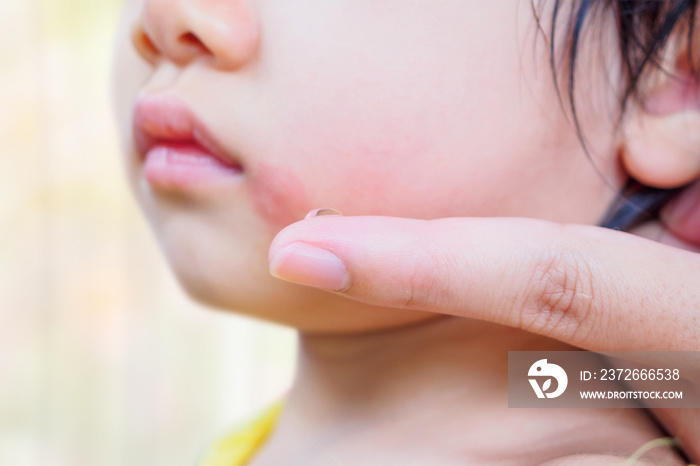 mother applying topical antihistamine cream at kid face with skin rash and allergy with red spot cau