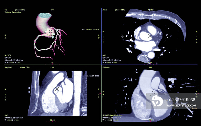 CTA Coronary artery  3D rendering image or coronary tree with axial , sagittal and coronal view  for diagnosis of vessel coronary artery stenosis .