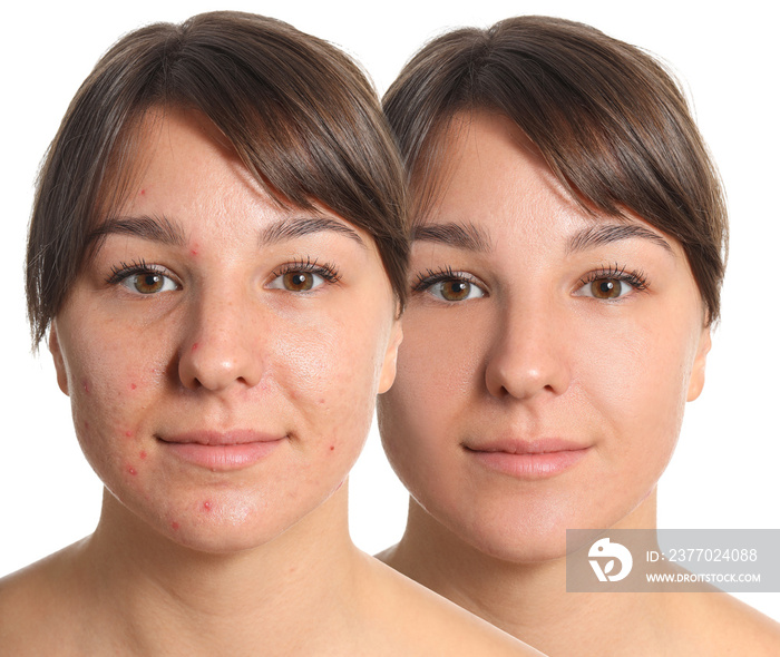 Young woman before and after acne treatment on white background