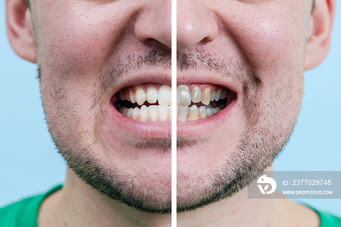 Man Teeth Before And After Whitening. Dentist work photo