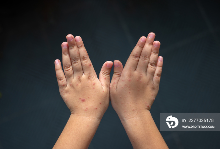 Rash on the hands of the Hand foot and mouth disease. Hand-foot-and-mouth disease is most commonly caused by a coxsackievirus and Enterovirus.