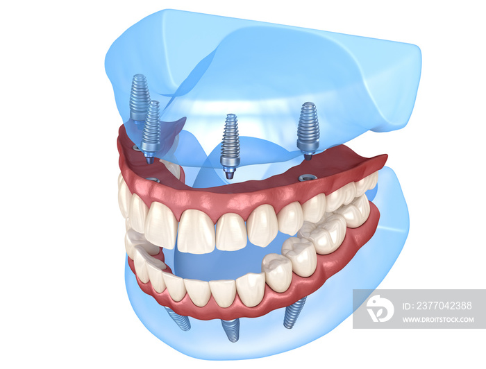 Maxillary and Mandibular prosthesis with gum All on 4 system supported by implants. Medically accurate 3D illustration of human teeth and dentures