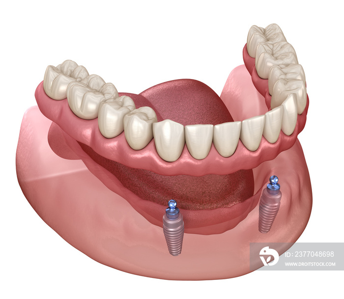 Mandibular removable prosthesis All on 2 system supported by implants with ball attachments. Medically accurate dental 3D illustration