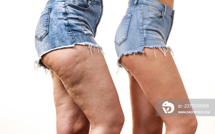 Comparison of legs with and without cellulite