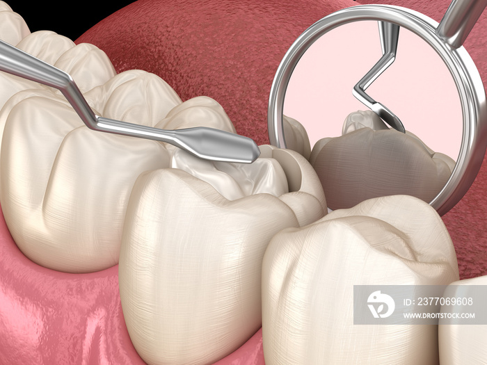 Decayed tooth restoration with composite filling. Medically accurate tooth 3D illustration.