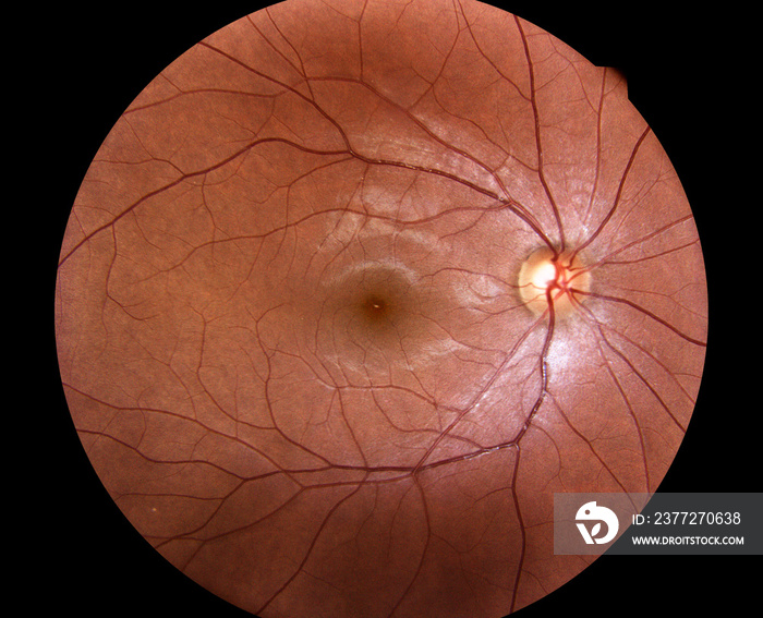 Medical photo retina of diabetic - exudate