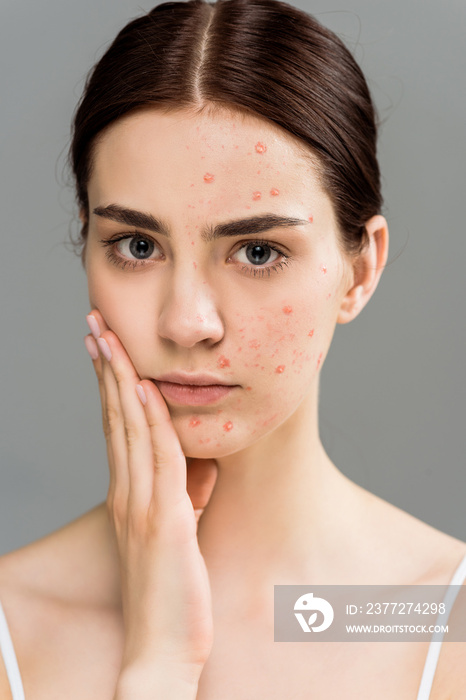 sad brunette woman with pimples touching face isolated on grey