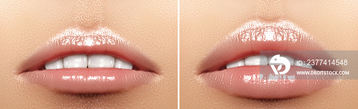 Before and after lips filler injections. Beauty plastic. Beautiful perfect lips with natural makeup.