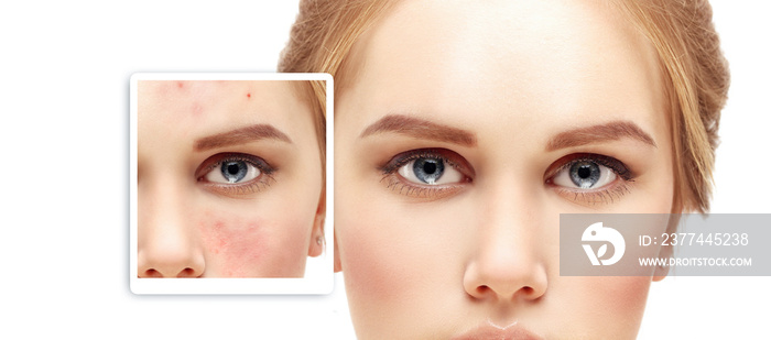 Post-Acne Marks .Treating Acne Scars.Acne Scar Removal