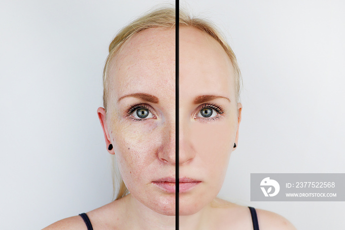 Oily skin and clear skin. Two photos before and after. Portrait of a girl with problem skin. Skin ca