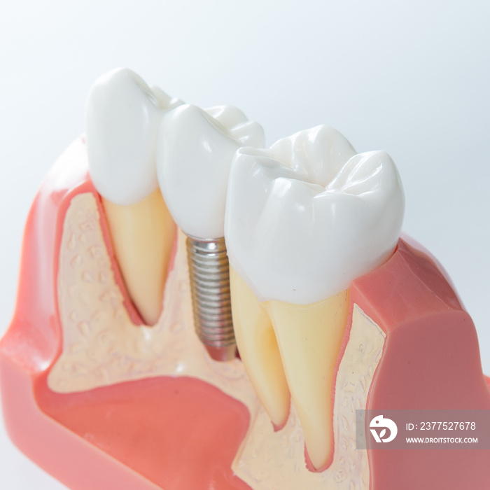 Dental implant