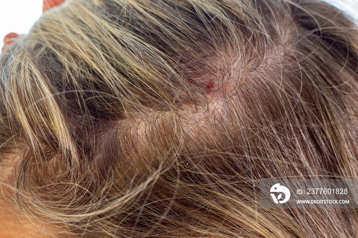 Psoriasis of the scalp , psoriatic redness, peeling and crusts on the scalp of an unrecognizable woman. An autoimmune, incurable dermatological skin disease.