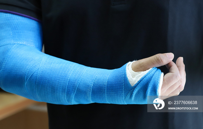 Closeup of Asian man’s arm with long arm plaster, fiberglass cast therapy cover by blue elastic bandage after sport injury.