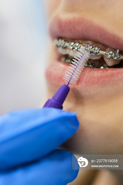 Close-up of dentist using interdental brush while cleaning patient’s dental braces.