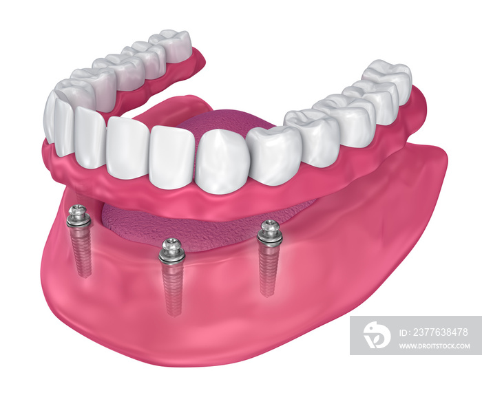 Overdenture to be seated on implants - ball attachments. 3D illustration