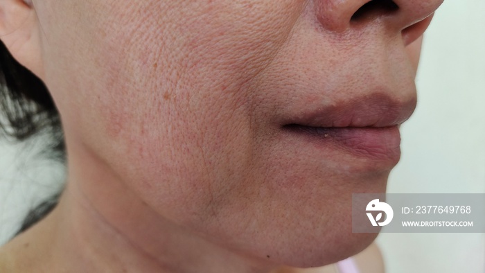 close up portrait showing the flabbiness skin beside the mouth, problem wrinkle and blemish skin on the face of the woman, concept health care.