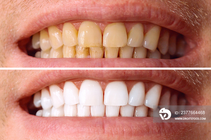 Teeth before and after whitening. Over white background. Dental clinic patient. Image symbolizes oral care dentistry, stomatology.