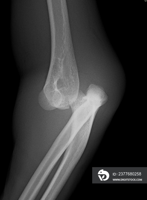 x ray of a elbow dislocation