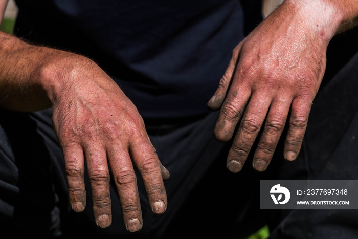 Tired , dirty, hard working caucasian man hands with a missing finger close up shot.