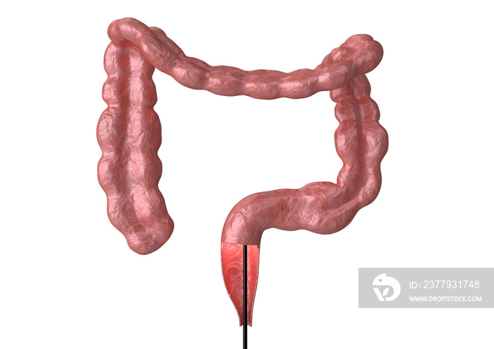 colonoscopy - is the endoscopic examination of the large intestine and rectum that helps in the disc