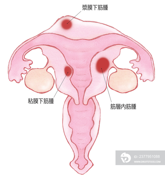 子宮筋腫　粘膜下筋腫、筋層内筋腫、漿膜下筋腫　名称あり