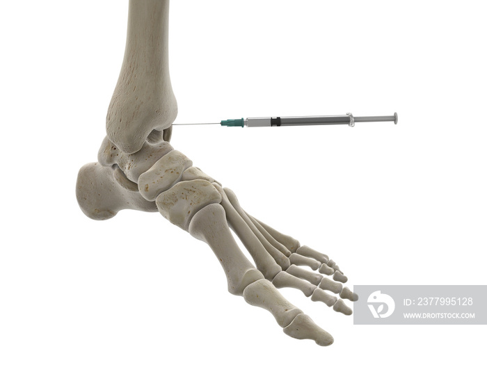 3d rendered medically accurate illustration of an ankle injection