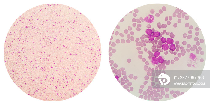 急性髓细胞白血病（AML）是血液癌症的一种。母细胞或白血病的显微镜检查