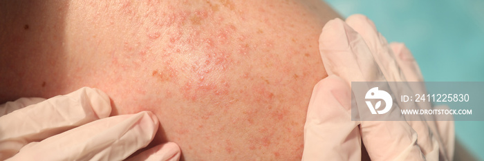 Doctor in rubber gloves examining skin of patient with red rash in clinic closeup