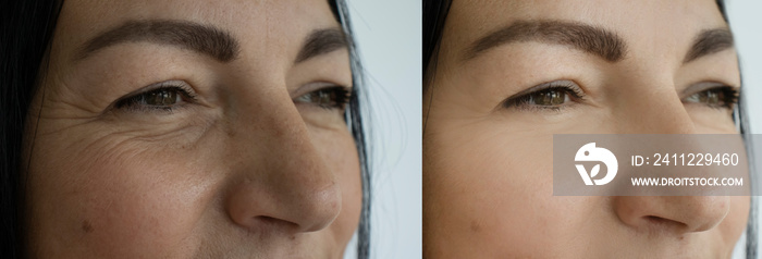 woman face wrinkles before and after treatment nt