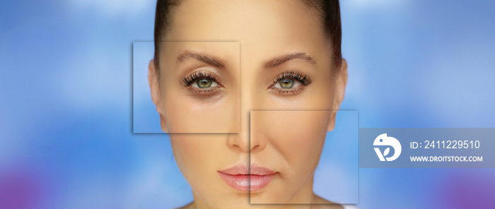 Effects of ageing,Nasolabial folds,Neck ,Under eye circles,neck lines. Plastic Surgery Results