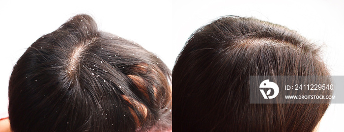 Image before and after dandruff treatment shampoo on hair woman. Problem health care concept.