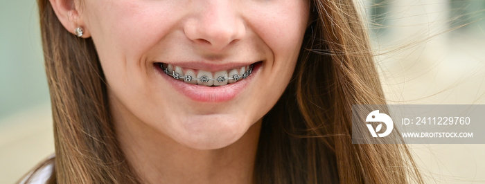 Joyful female with orthodontic brackets. Concept of dentistry.