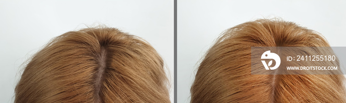 woman hair baldness before and after treatment