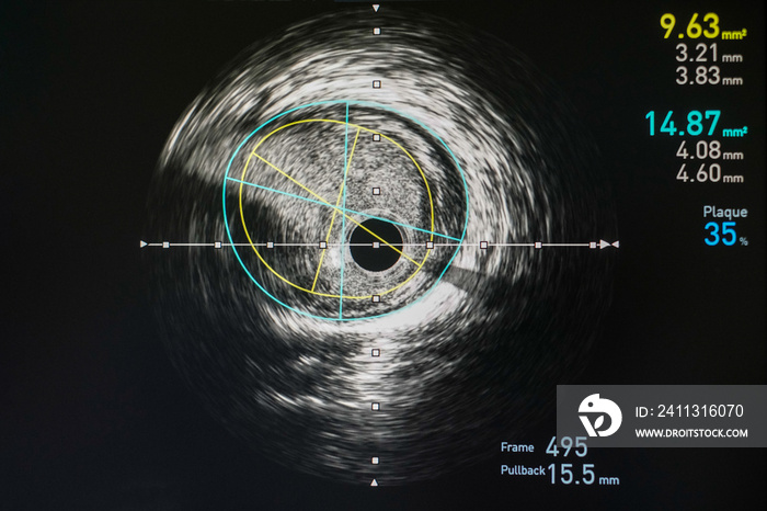 Intravascular ultrasound imaging (IVUS) at cardiac catheterization laboratory room.