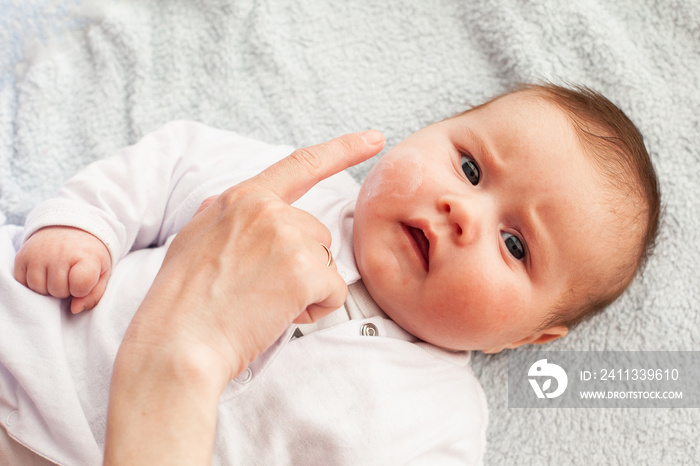 Baby with atopic dermatitis getting cream put. Care and Prevention Of Eczema.