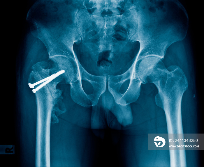 fixation hip by screw x-ray, image of x-ray hip fracture and post operation hip fixation by screw