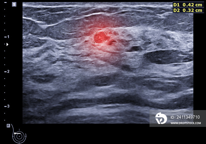 ultrasound  breast of Patient after mammogram  for diagnonsis Breast cancer in women isolated on black background.